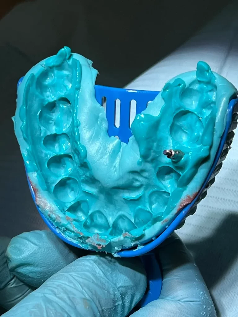 Implant-Supported Bridge North York