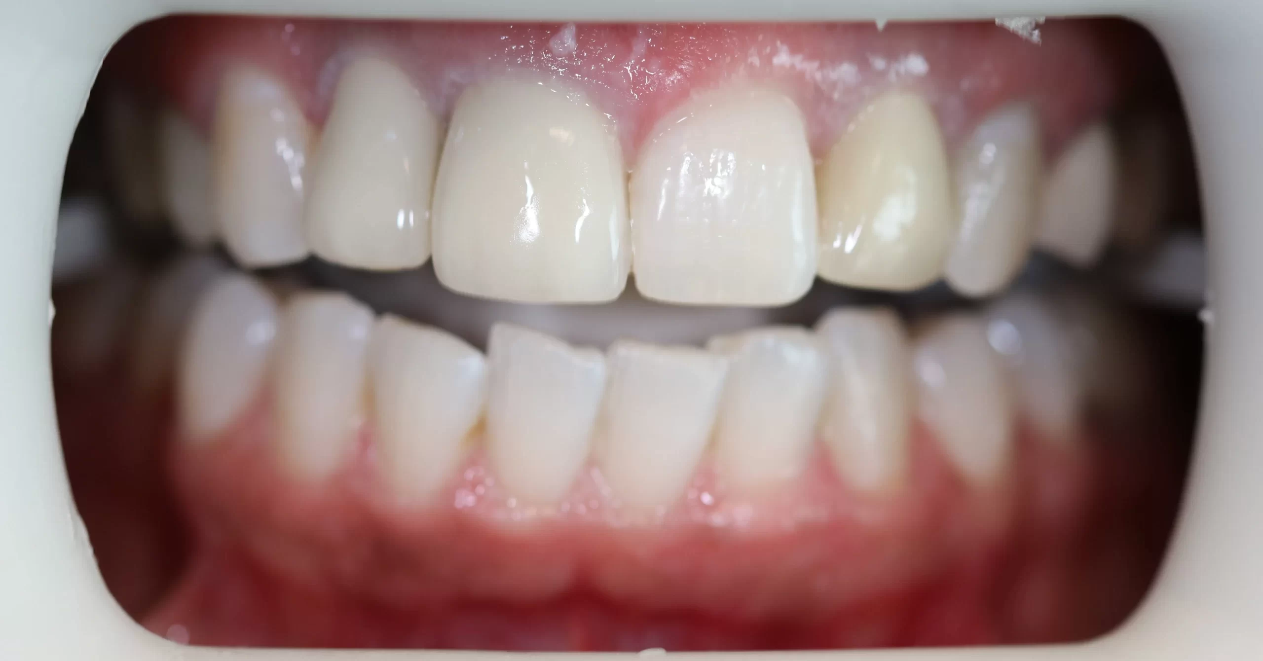 Teeth Whitening Toronto