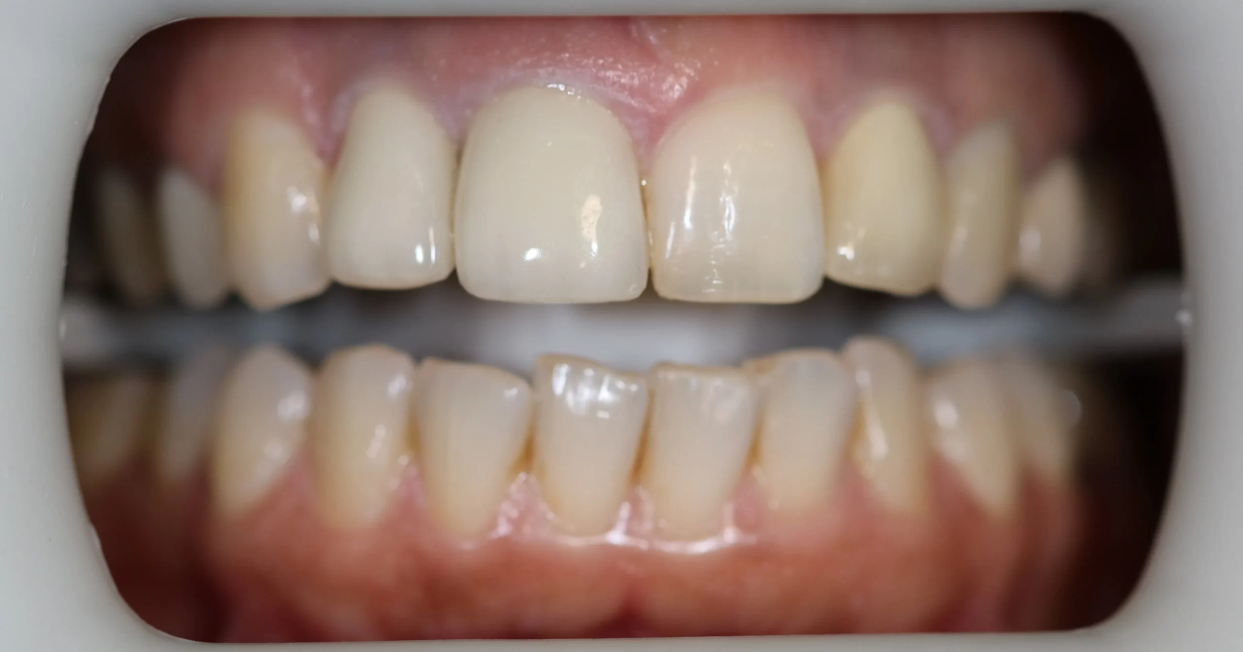 Teeth Whitening Toronto