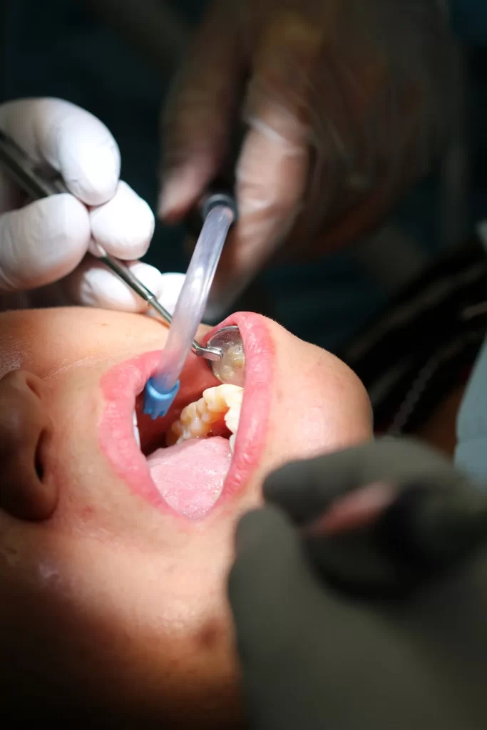White Fillings North York