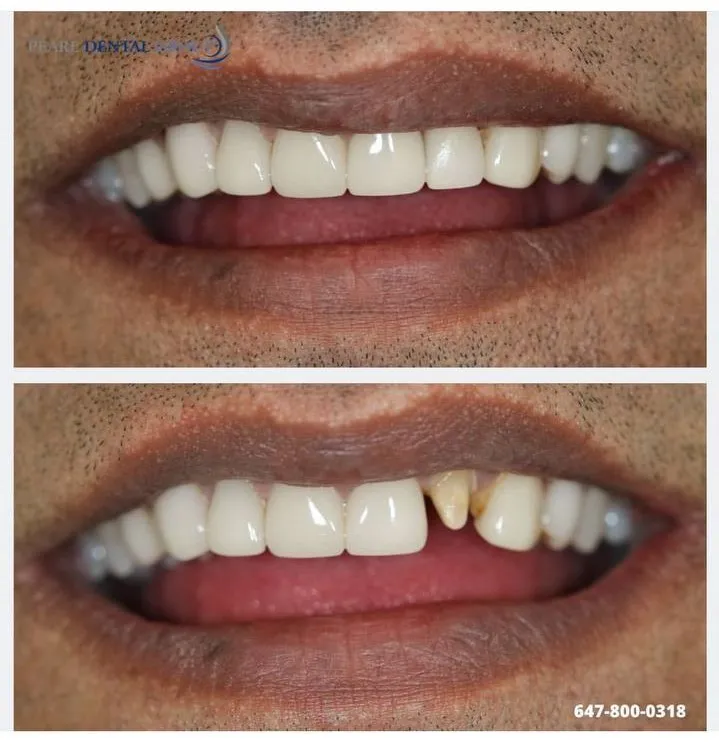 Before and after emergency veneer restoration at Pearl Clinic Toronto
