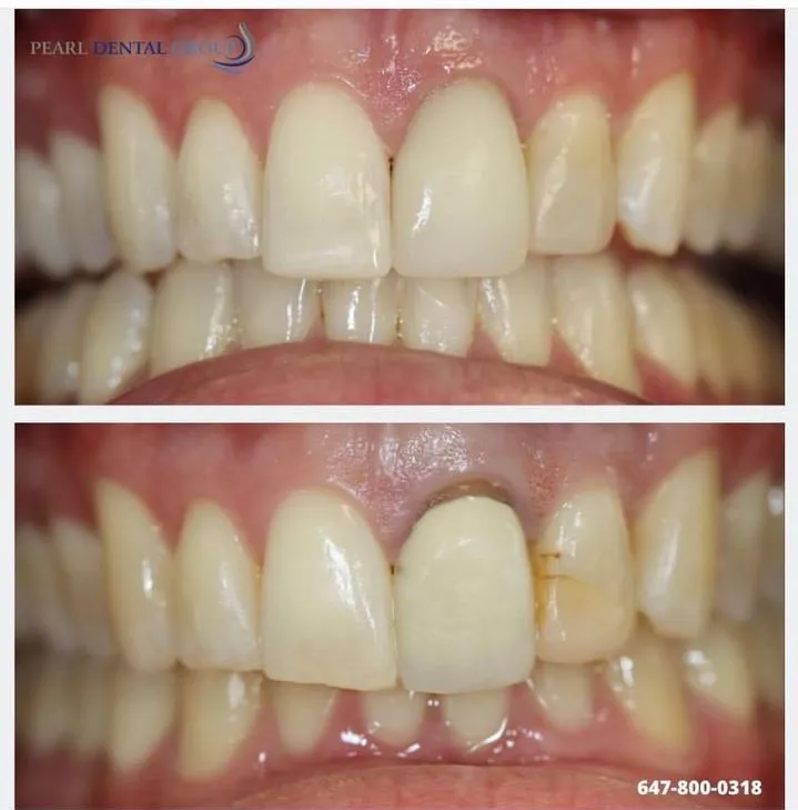 Before and after emergency veneer restoration at Pearl Clinic Toronto