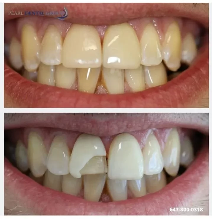 Before and after emergency veneer restoration at Pearl Clinic Toronto