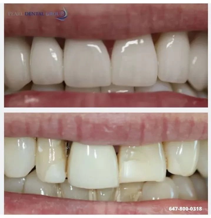 Before and after emergency veneer restoration at Pearl Clinic Toronto