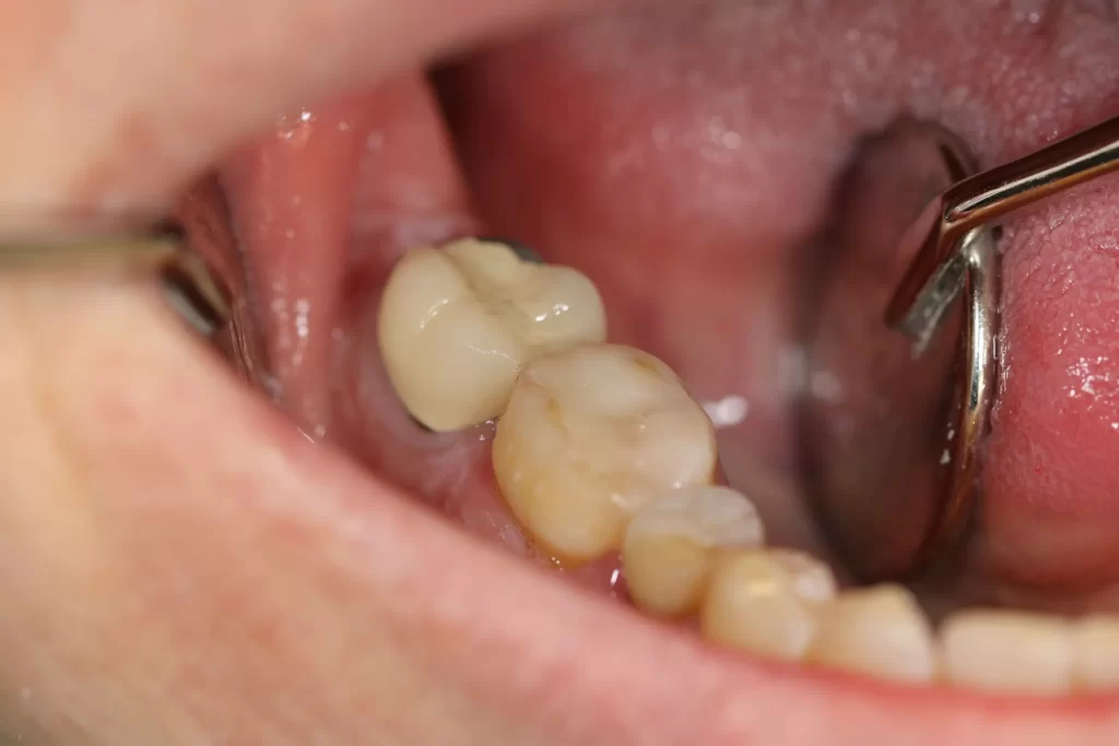 Cosmetic Dental Fillings for Decayed Teeth