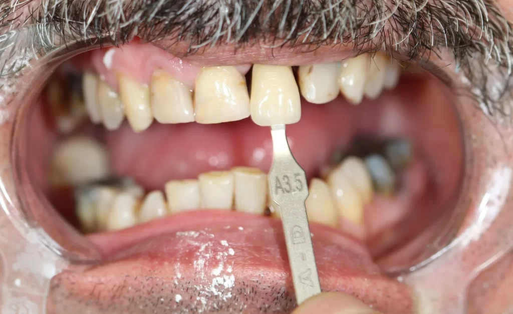 Our Dental Implant Services in North York