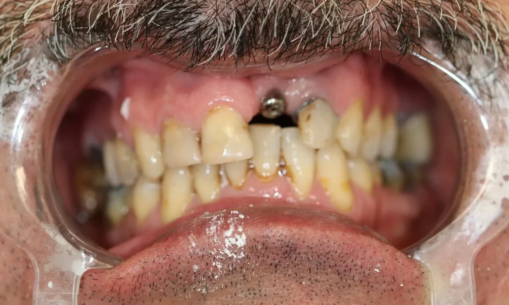 Our Dental Implant Services in North York
