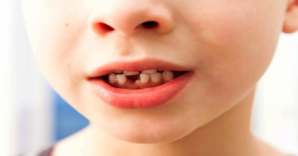 Can a Knocked-Out Tooth Be Saved