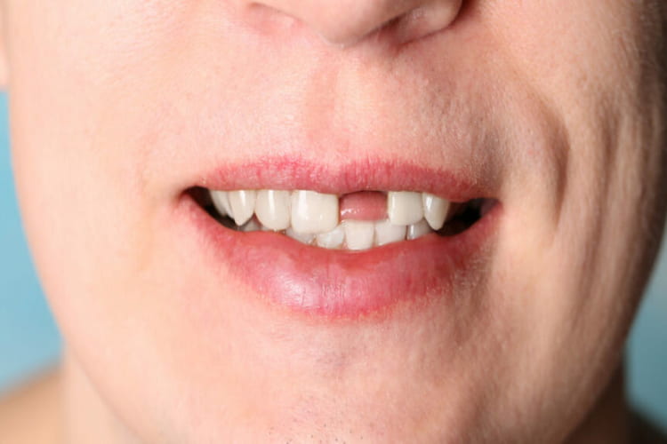 Immediate Actions After a Knocked-Out Tooth