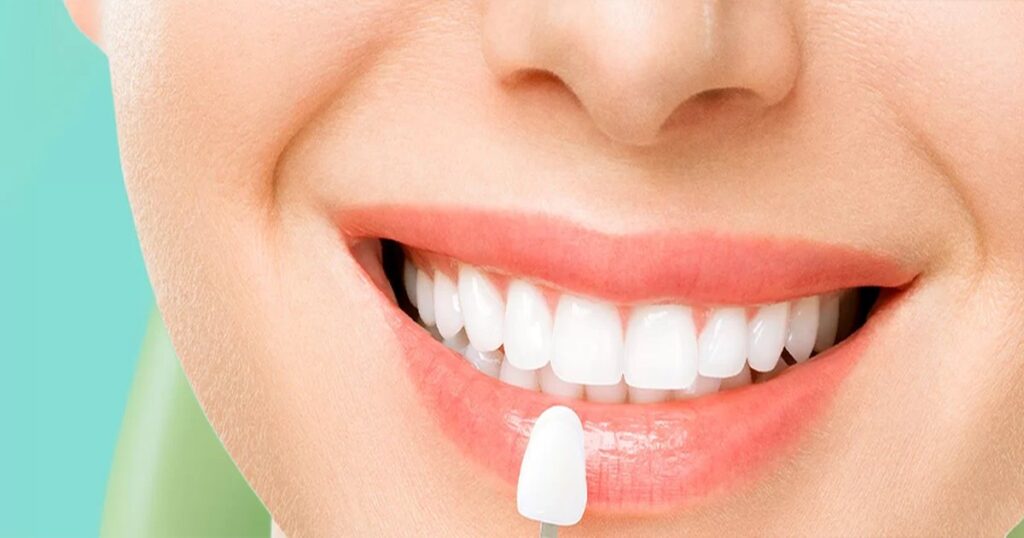 composite veneer lifespan