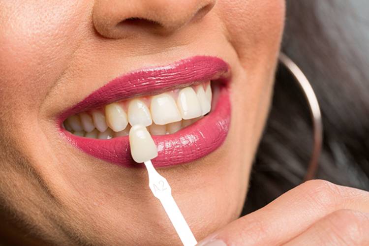 Average of composite veneer lifespan