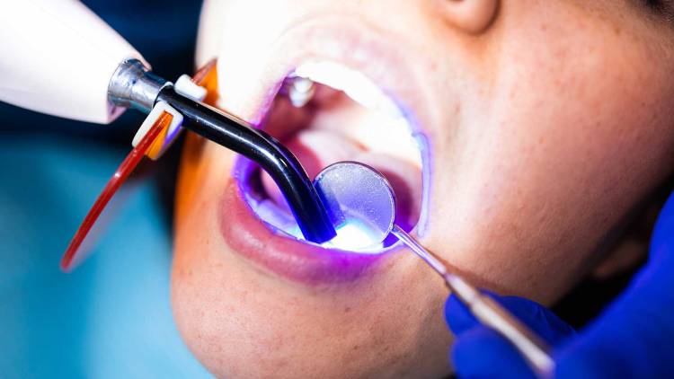 Mistaken belief about dental composite bad breath