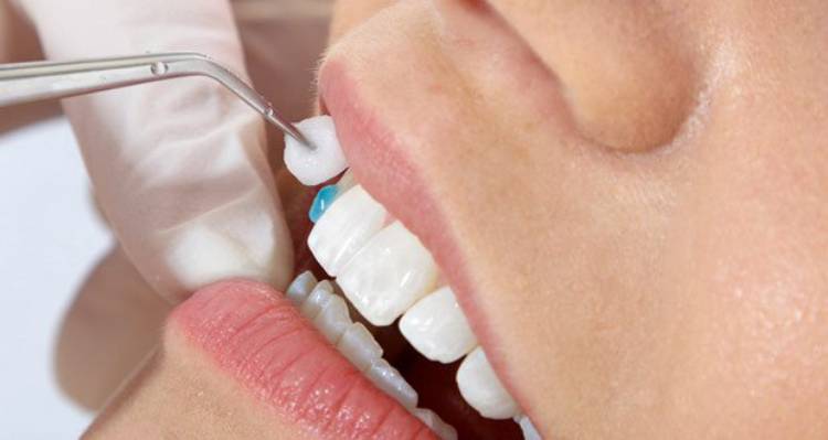 Truth about dental composite bad breath