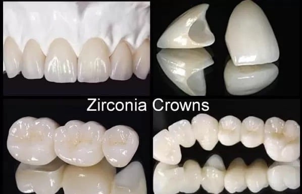 the best materials for dental crowns in 2026