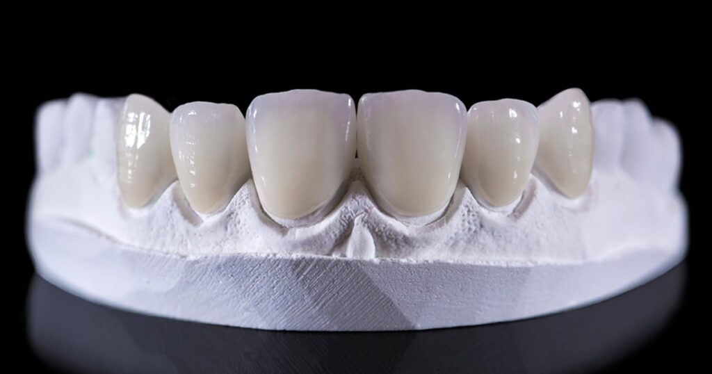 All you should know about dental crown glue