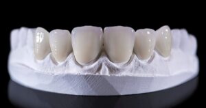All you should know about dental crown glue