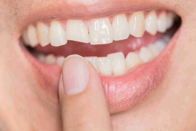 All you need to know about whiten fillings on front teeth
