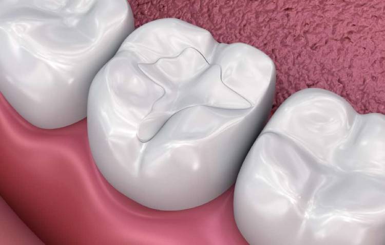 Whiten fillings on front teeth; full guide