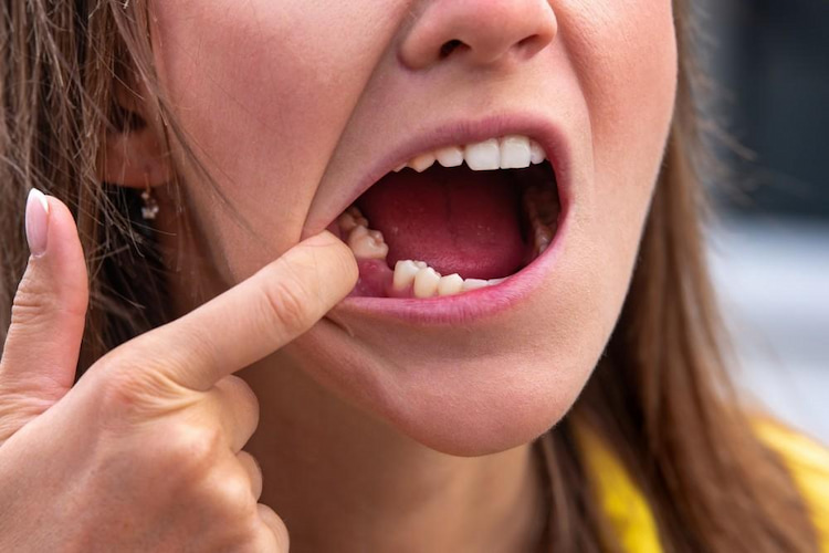 a photo of a lady with a knocked-out tooth