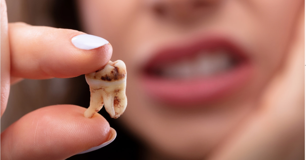 a photo of what a knocked-out tooth looks like