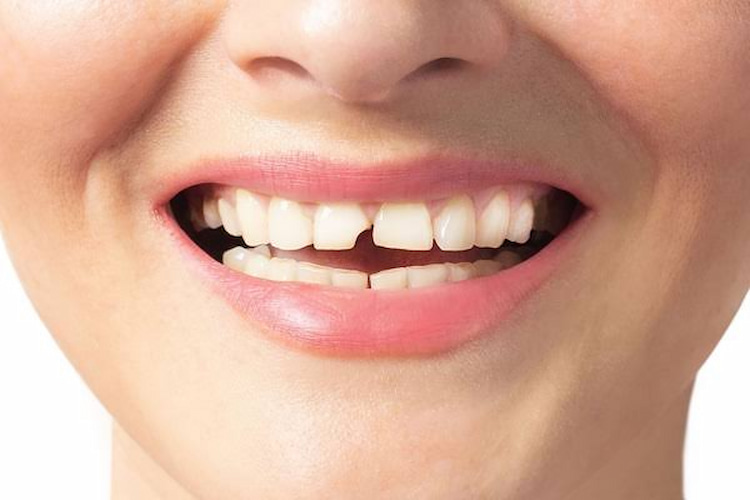 a photo of a broken tooth as a dental emergency