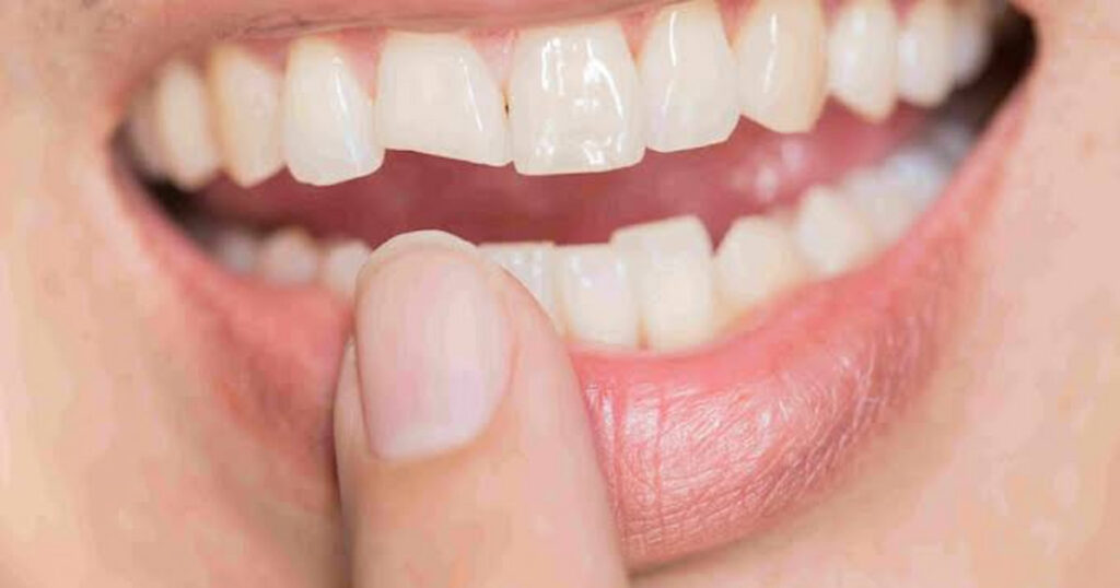 a photo of lady pointing to a cracked tooth