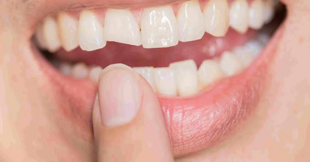 a photo of lady pointing to a cracked tooth