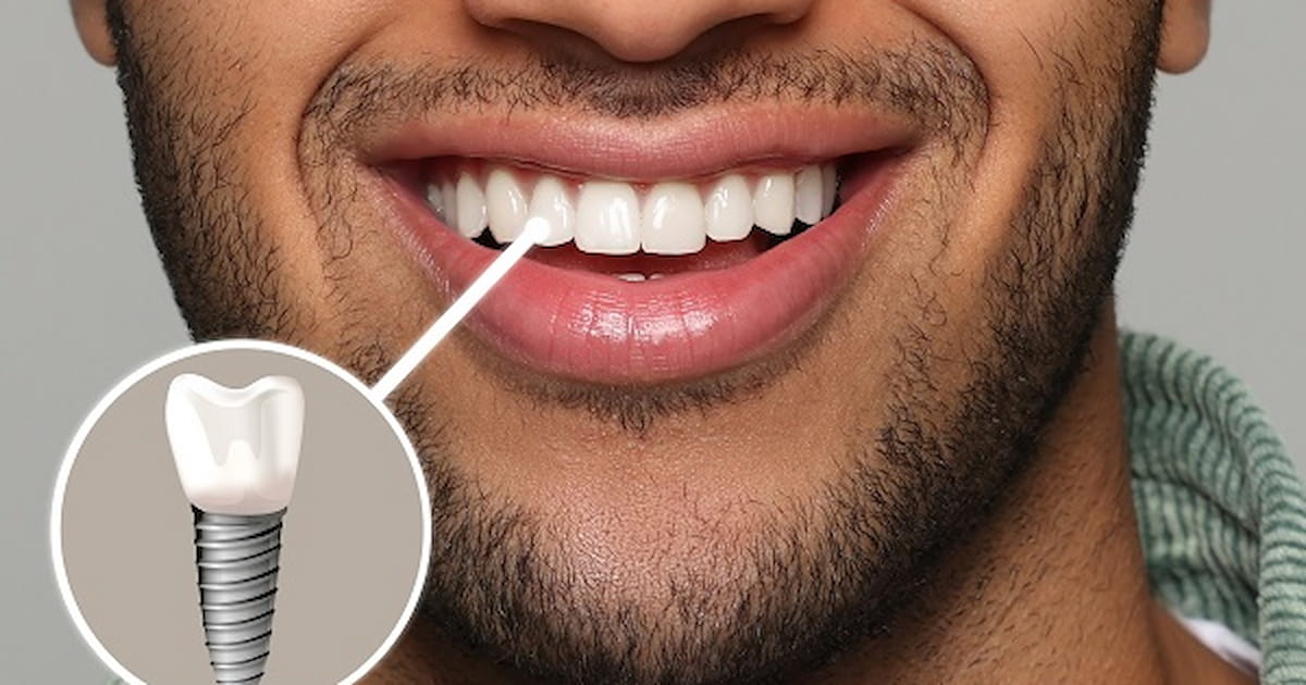 a photo of a person smiling with screwless dental implants