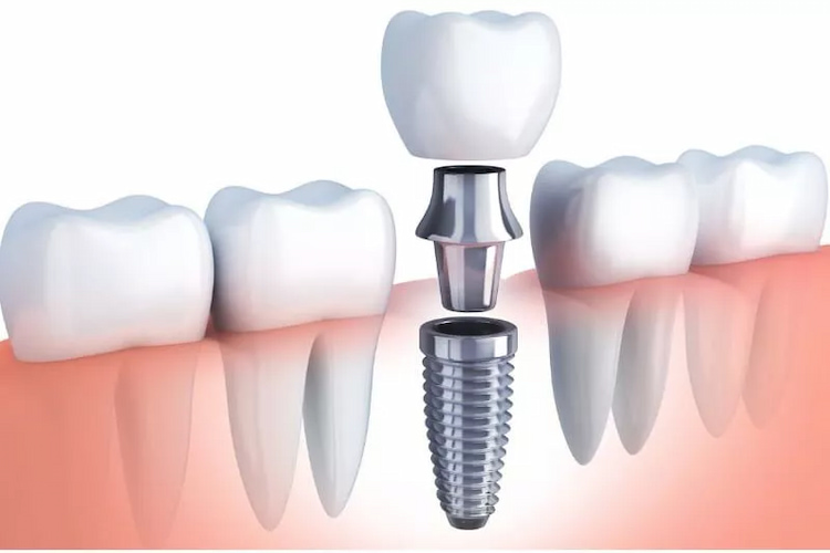 a photo showing dental implants