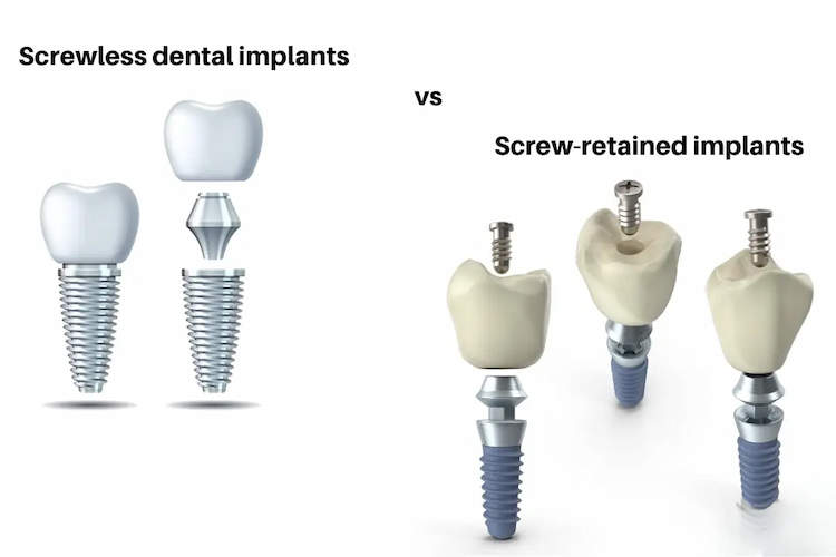 a photo of what screwless dental implants are
