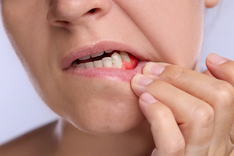 a photo of a lady pointing out to a tooth abscess