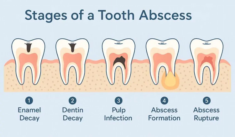 a photo of tooth abscess stages