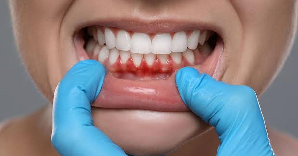 a photo showing tooth abscess stage 1