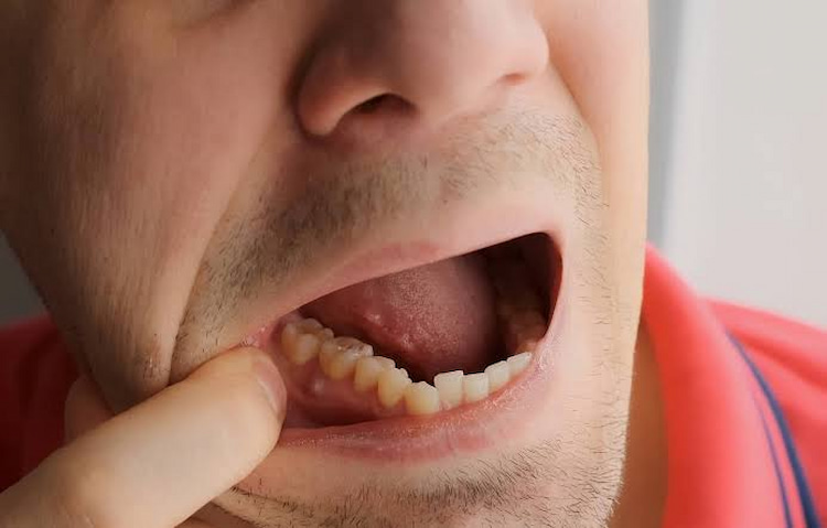 a photo of a tooth abscess stage 2