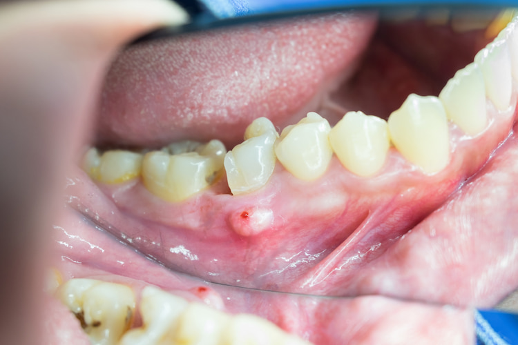 a photo of tooth infection