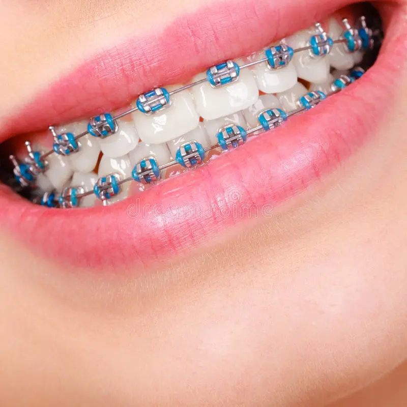 a girl wearing blue braces