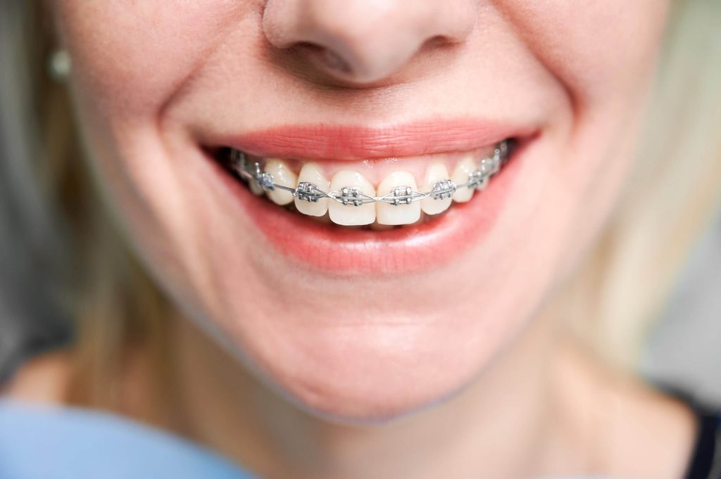 a girl with silver braces