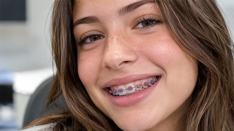 Girl smiling with pink and purple braces, showcasing one of the best braces colors for girls.