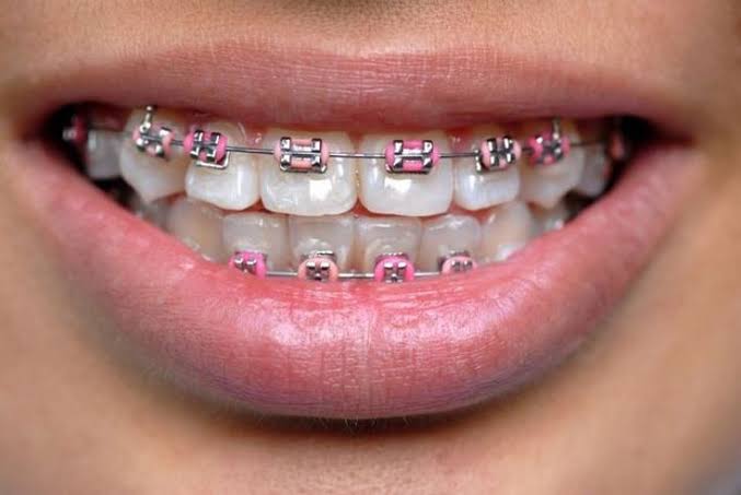 a girl with pink braces