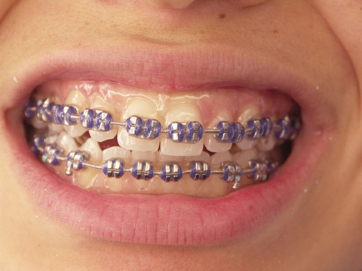a girl with purple braces