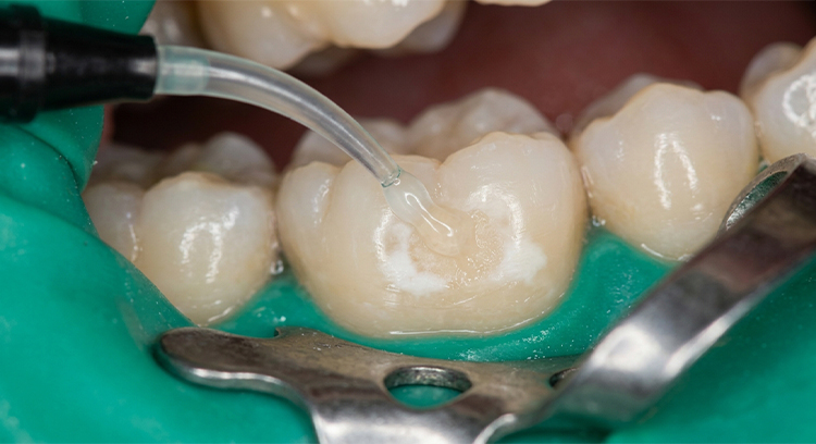 resin inflitration