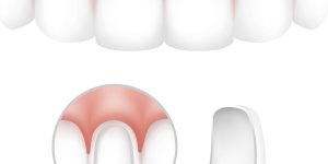 dental veneers toronto