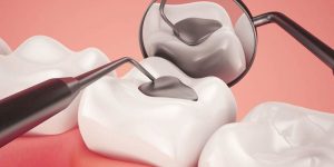 Best Material for Dental Fillings