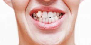 dental veneers for crooked teeth