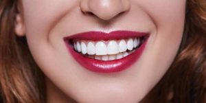 How Long Do Veneers Last?