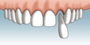 Can a Knocked-Out Tooth Be Saved? Here’s What You Need to Know