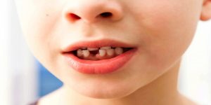 Can a Knocked-Out Tooth Be Saved