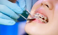 Orthodontic at pearl dental group