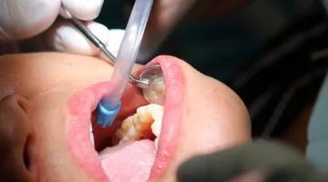 White Fillings North York