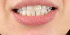 White Spots on Teeth